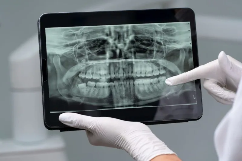 Radiografiile dentare, esentiale pentru sanatatea dentara