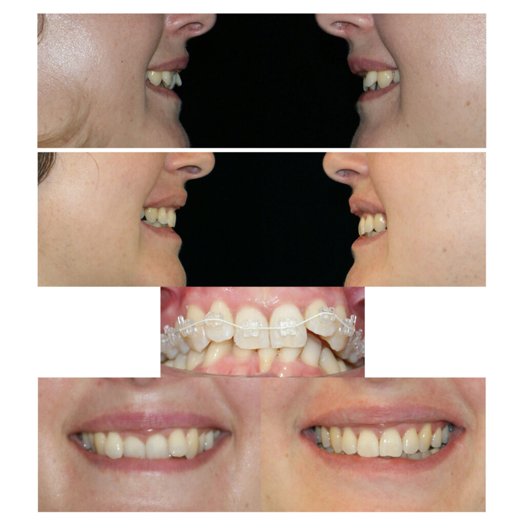 #brackets